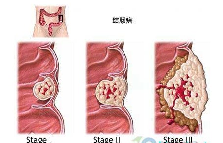 肠癌中期图片