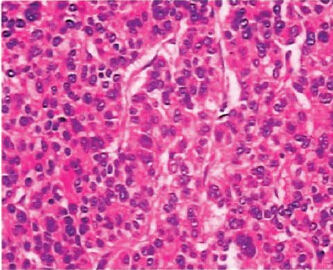 45岁男性肝癌肝中叶切除并胆管重建术后无复发病例分析