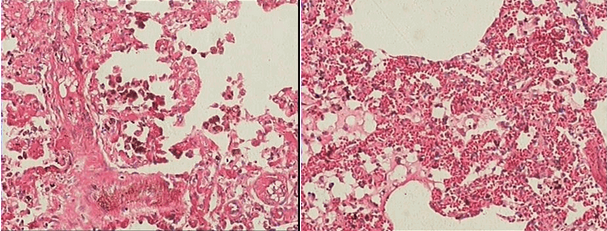 肺泡腔内有水肿液，红细胞及心衰细胞