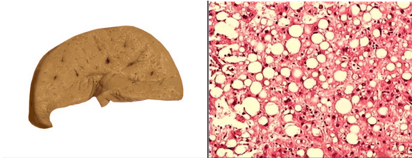 肝脂肪变性切片图图片