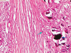 右肩钙化性腱膜纤维瘤