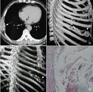 肋骨肿瘤恶性的图片图片