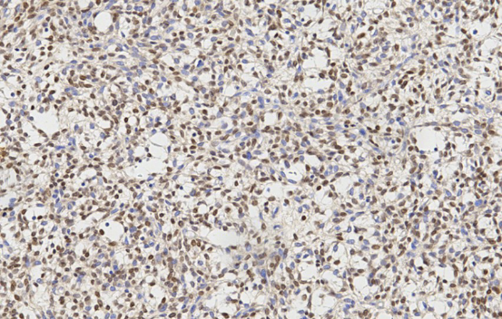 SFT肿瘤CD34阳性