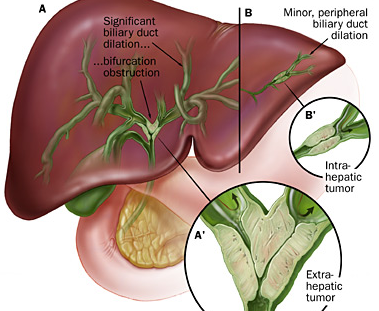 胆管癌中医治疗方法根据病理组织学分型