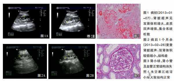 26歲女性患雙胎妊娠產後急性腎皮質壞死入院治療病例分析