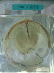 脑脓肿标本图片