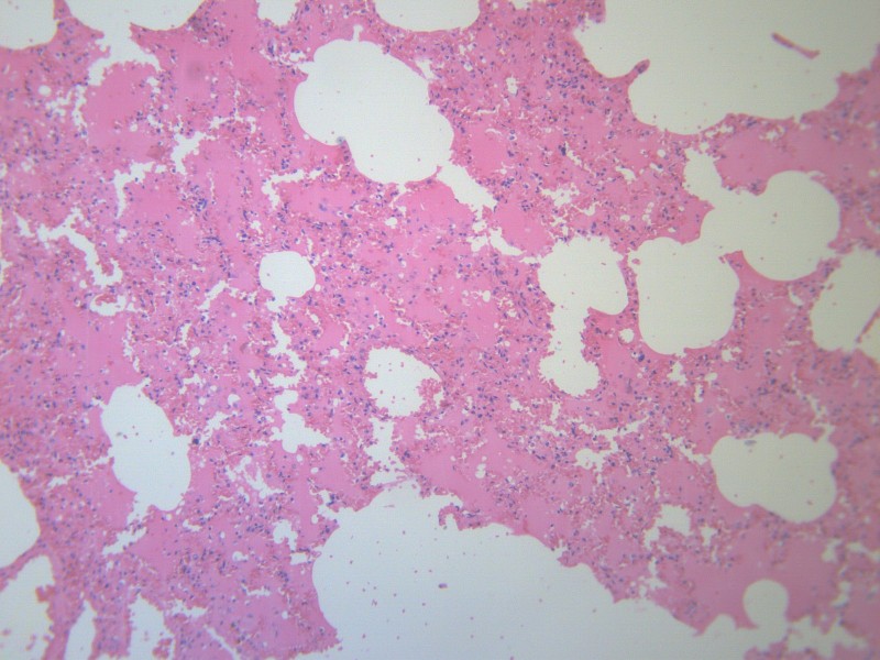 病理学呼吸系统疾病之小叶性肺炎
