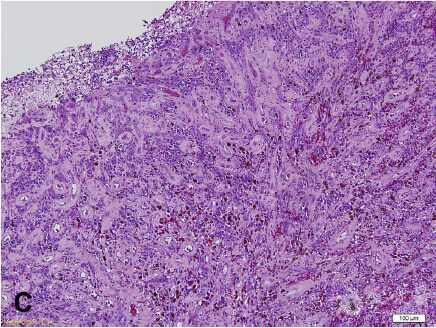 40岁男性患非"肉芽肿"的化脓性肉芽肿入院治疗病例分析