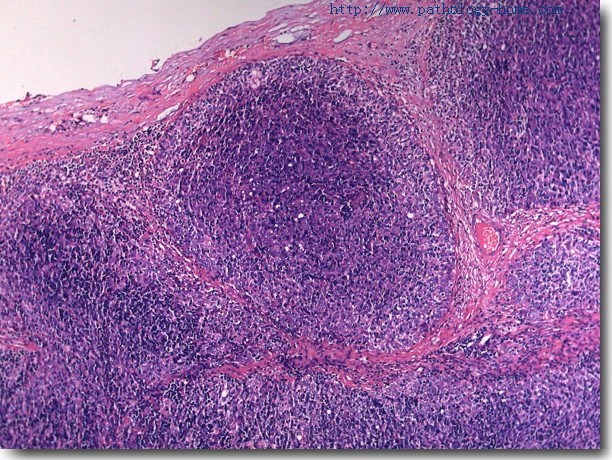 良性乳腺肿瘤切片颜色图片