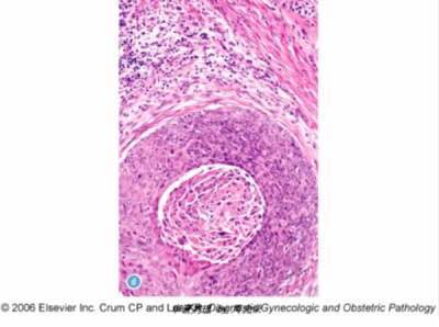 周先荣—《子宫微小浸润癌的识别》
