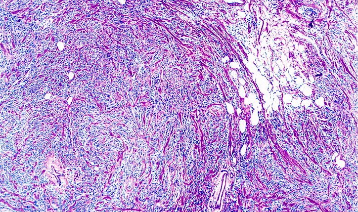 乳腺低度恶性梭形细胞瘤(类似纤维瘤病 病理杂谈 91360智慧病理