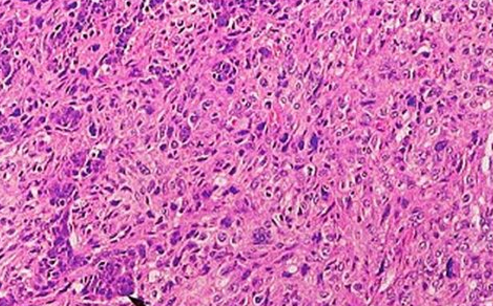 梭形细胞肿瘤病理诊断及鉴别诊断