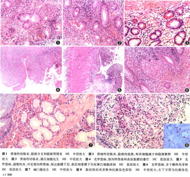 保险哪些病要如实告知 平安保险溃疡性结肠炎