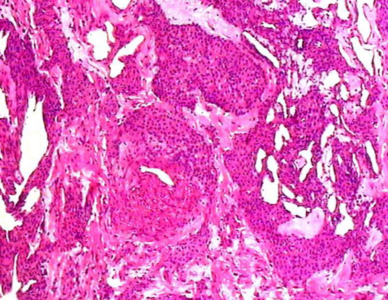 血管球瘤病理及鉴别诊断
