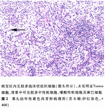 x     性别:男      年龄:6个月      临床资料:因"发现左阴囊内肿物2