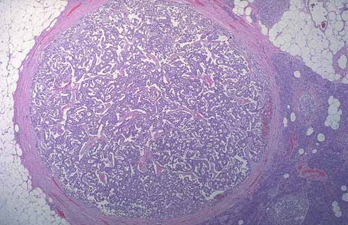 pancreatic islet cell tumor)又称胰岛细胞腺瘤(islet cell adenoma)