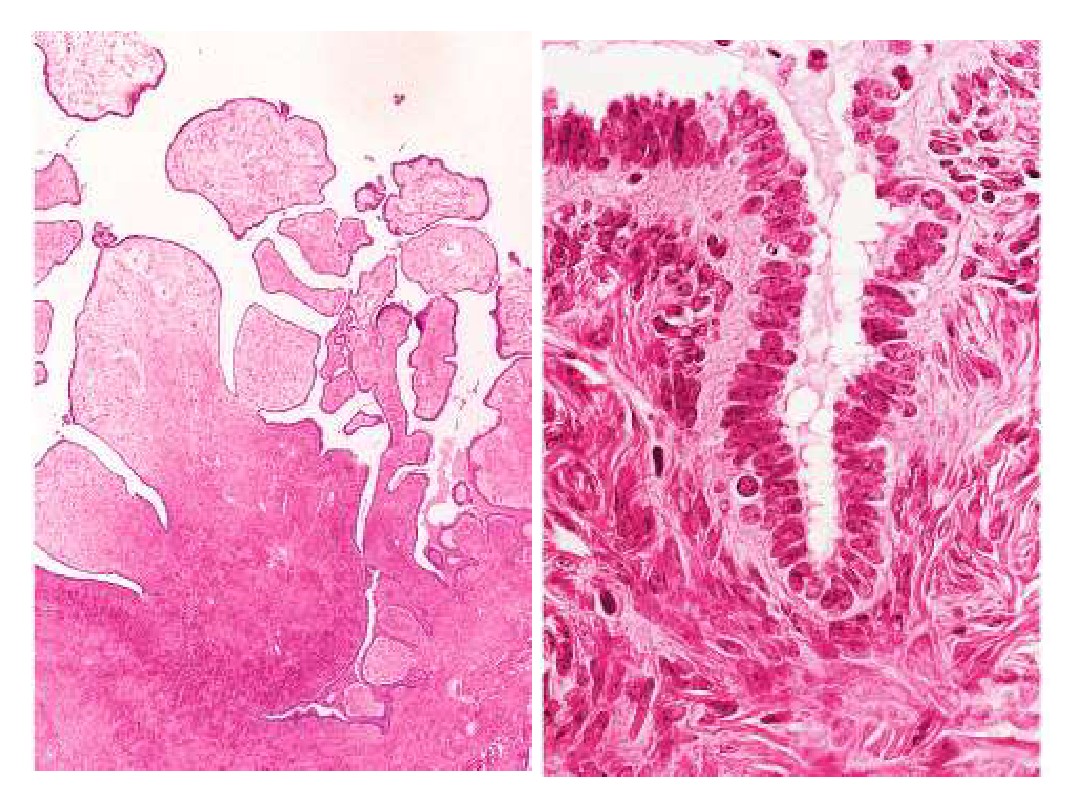 卵巢浆液性交界性肿瘤的病理诊断