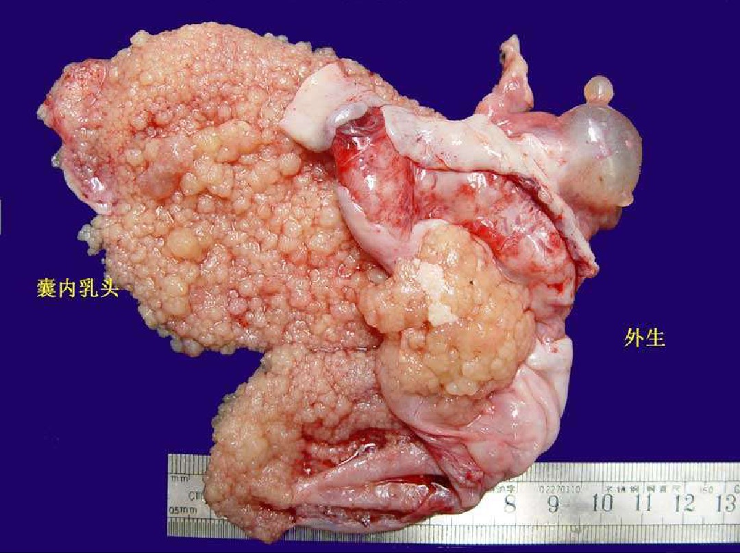 卵巢良性肿瘤图片图片