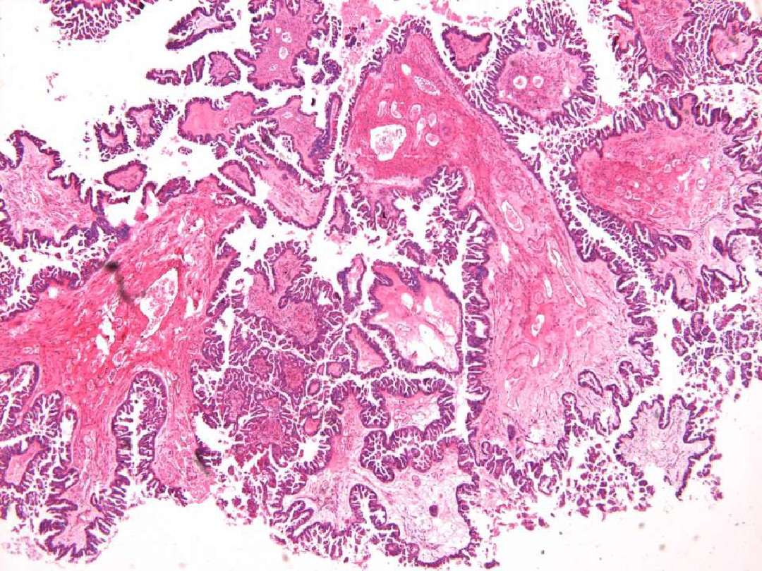 【附图】乳腺导管原位癌钼靶摄片及MRI表现_乳腺肿瘤学 | 天山医学院