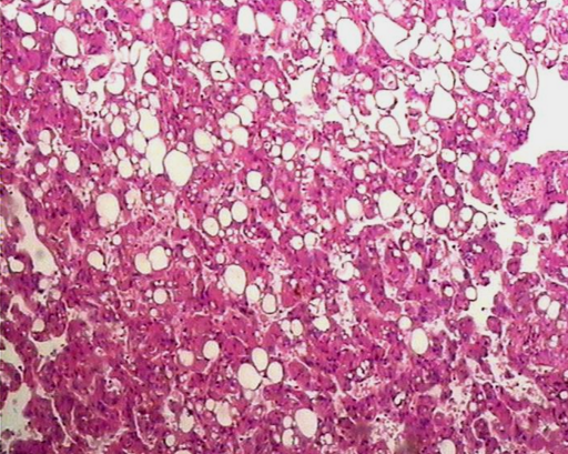 肾错构瘤的病理及鉴别诊断