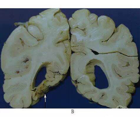 脑软化的病理改变