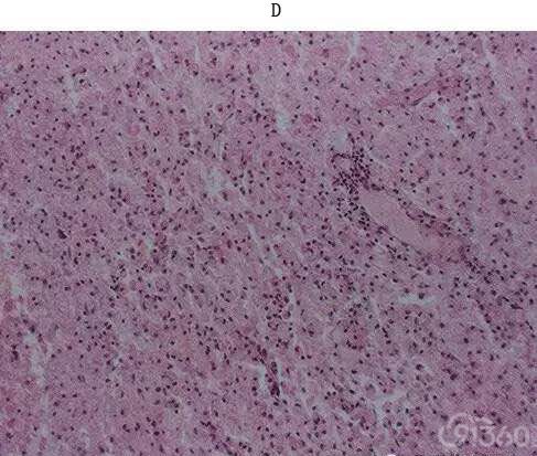 脑软化的病理改变