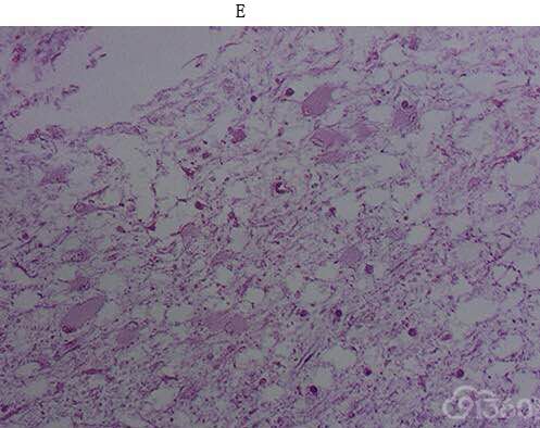 脑软化的病理改变