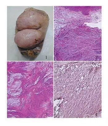 丛状神经鞘瘤临床与病理