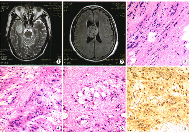 脑实质及侧脑室的室管膜下瘤临床病理
