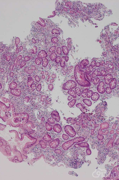 胃(体)组织活检(苏木精-伊红染色),40