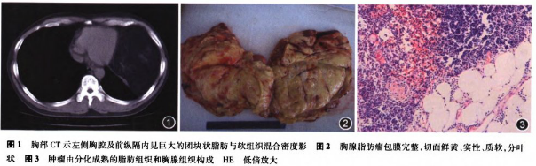 胸腺脂肪瘤