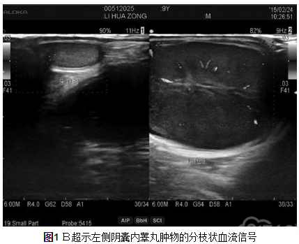 b超示左側陰囊內睪丸腫物的分枝狀血流信號