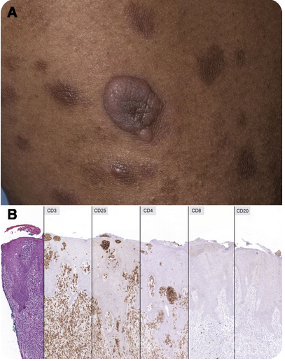 36岁女性患t细胞白血病/淋巴瘤入院治疗病例分析
