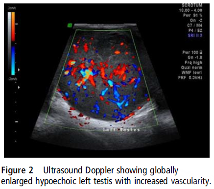 陰囊的多普勒超聲波檢查
