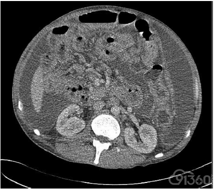 ct:腹膜后和中心肠系膜淋巴结病和轻微的双边积液