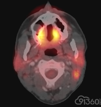 PET-CT扫描显示泪腺增大，双边具有FDG亲和性，与MCL相关