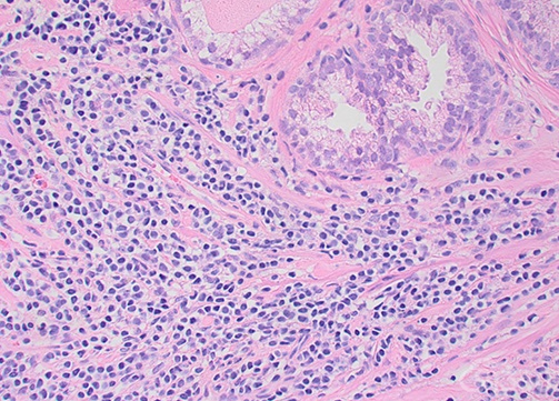 在前列腺MCL样本中，肿瘤细胞表现为浸润型