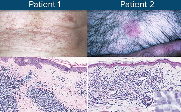 MCL损伤皮肤的临床和组织病理学特征