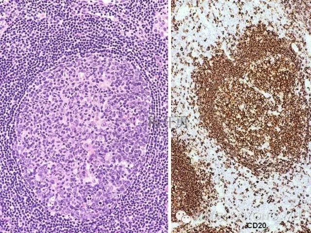 淋巴瘤病理诊断基础