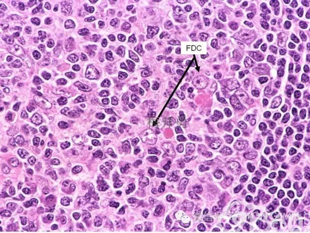 淋巴瘤病理诊断基础