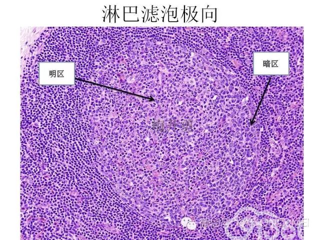 淋巴瘤病理诊断基础