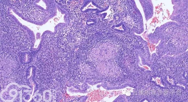 子宫内膜结核一例