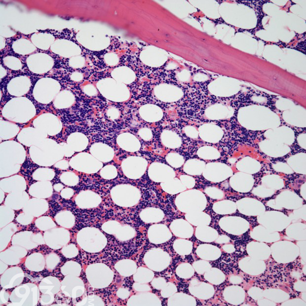 图5 骨髓活检所示cll,可见异型淋巴细胞