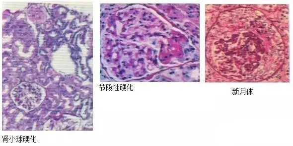 肾小球疾病的病理诊断