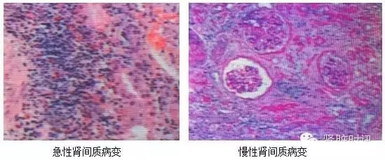 肾间质基本病变