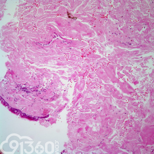 图10 高倍镜视野下,肝脏淀粉样沉积