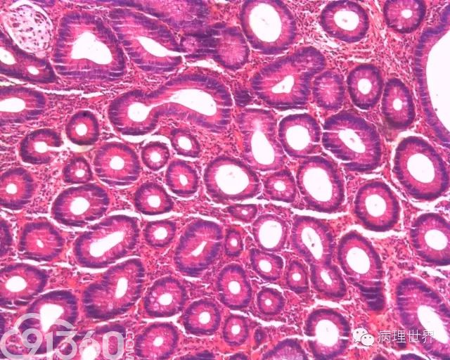 结肠管状腺瘤病理图片图片