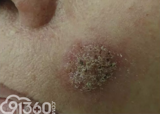 皮肤芽生菌病在皮肤镜和临床病理中的表现