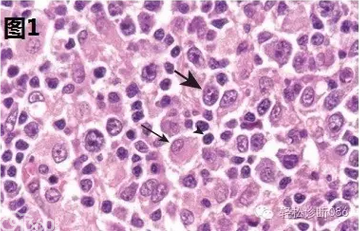 侵袭性B细胞淋巴瘤-DLBCL(1)