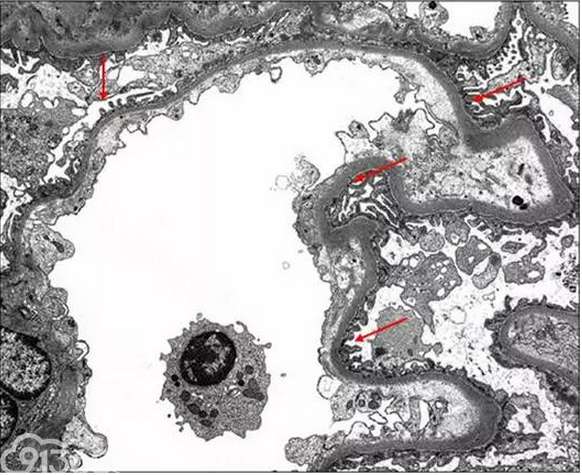 图27 适应不良性 FSGS